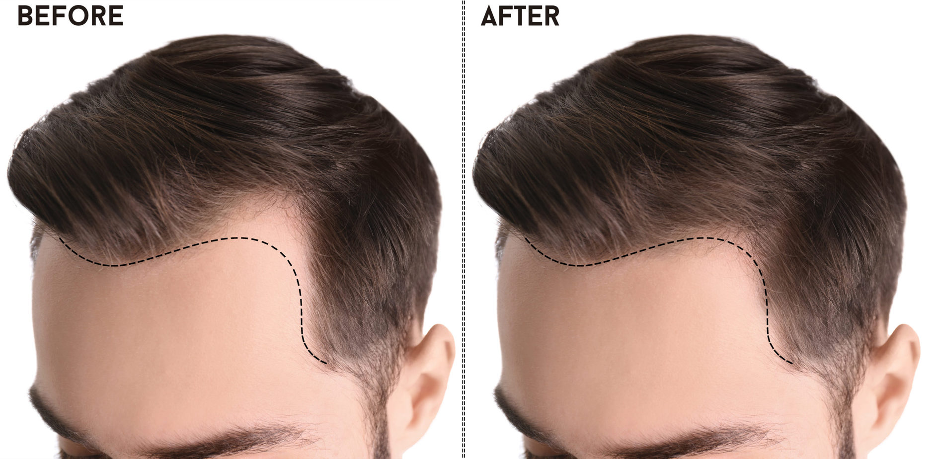 hair loss before and after