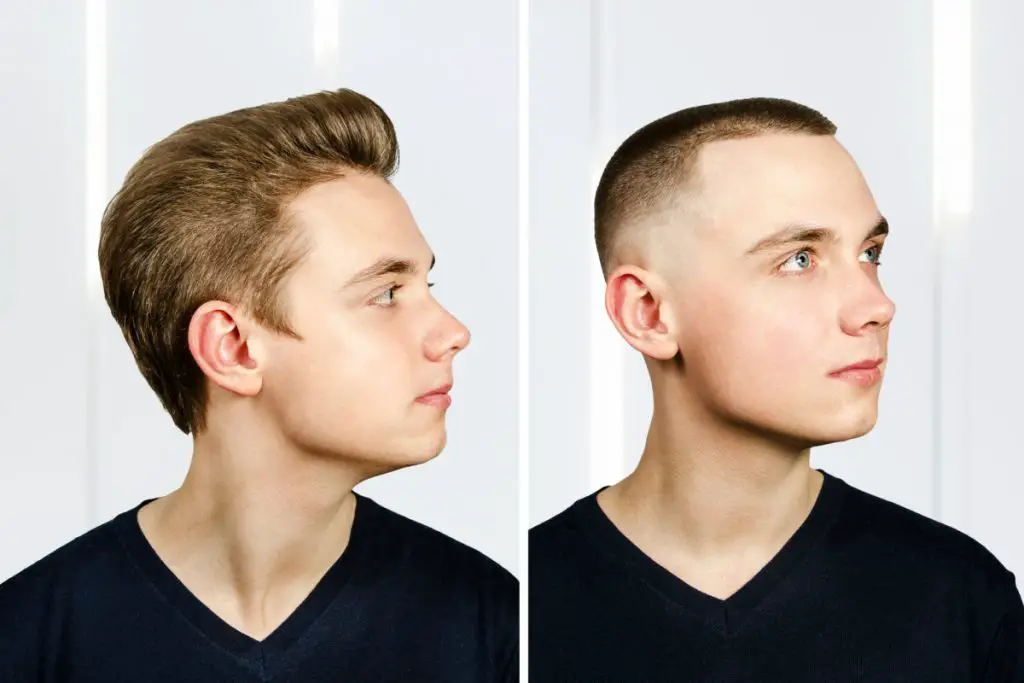 The Pros and Cons of Hair Transplants