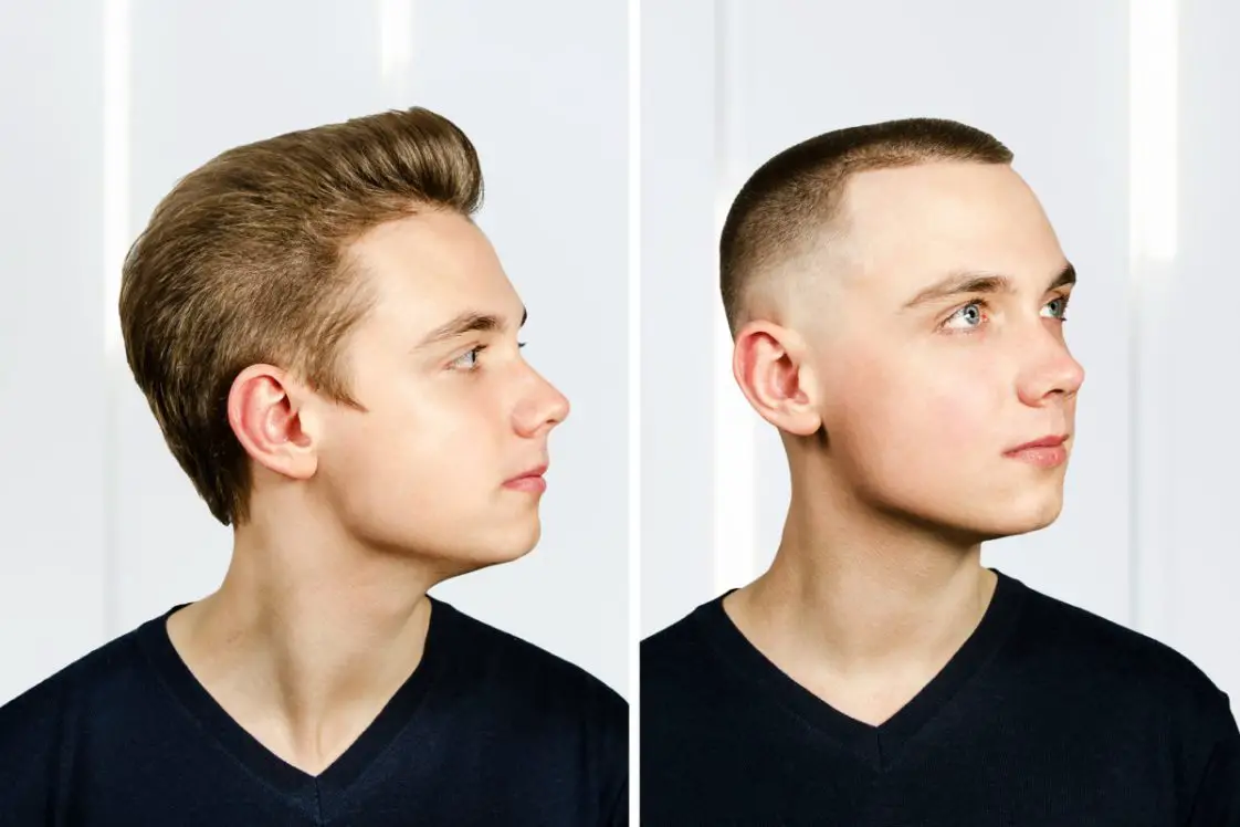 The Pros And Cons Of Hair Transplants