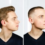 The Pros and Cons of Hair Transplants
