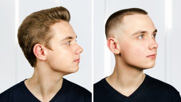 The Pros and Cons of Hair Transplants