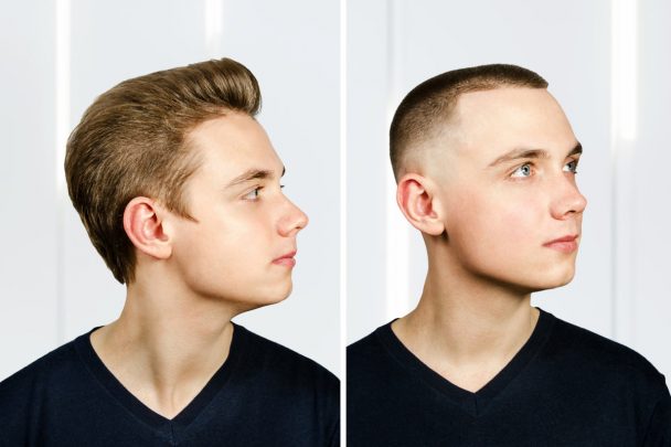 The Pros And Cons Of Hair Transplants