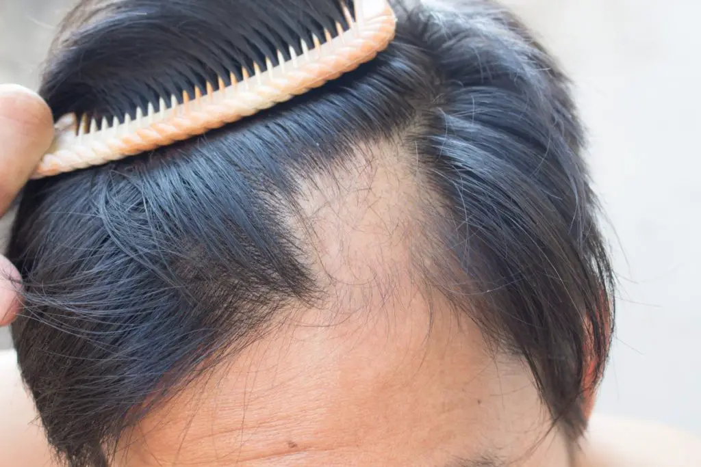 Can Depression Lead To Hair Loss?