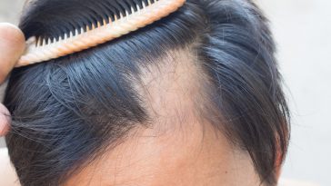 Can Depression Lead To Hair Loss?