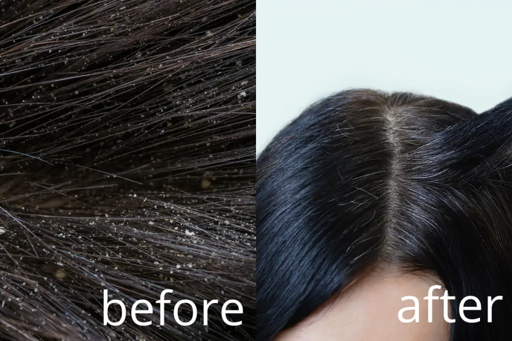 before after korean hair routine for dandruff