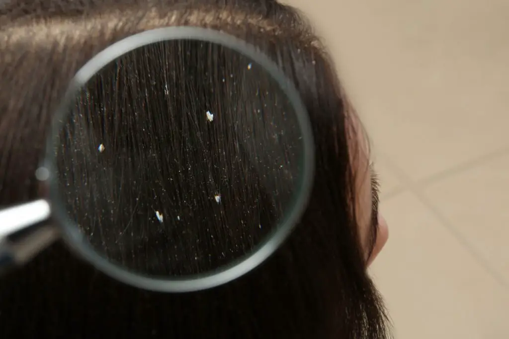 The 5 Step Korean Hair Routine For Dandruff