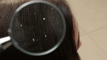 The 5 Step Korean Hair Routine For Dandruff