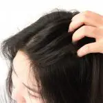 Can Mosquitoes Bite Your Scalp